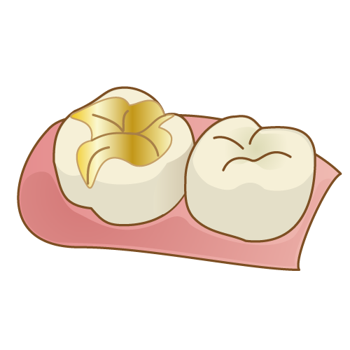 金合金【自費診療】